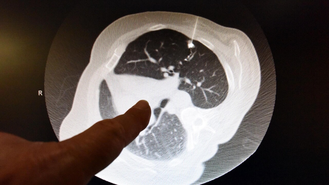 Lung cancer, the new therapy (in tablets) that stops the appearance of metastases
