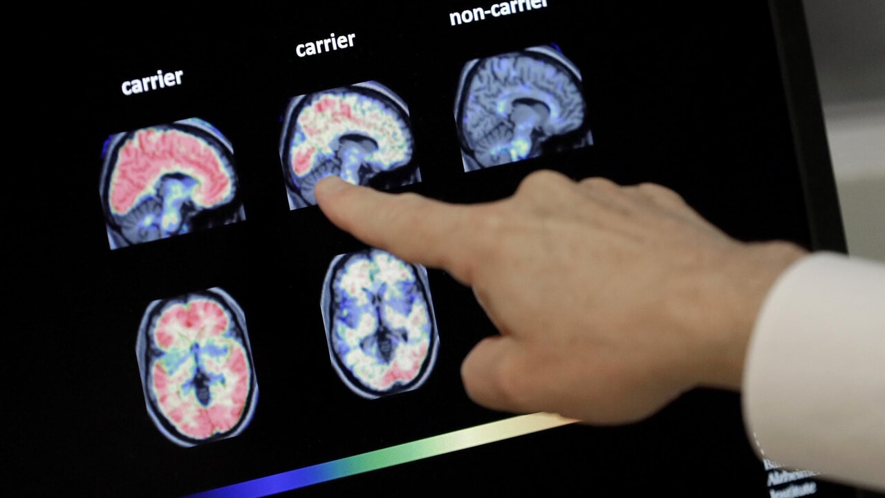 What's this about Viagra to prevent Alzheimer's