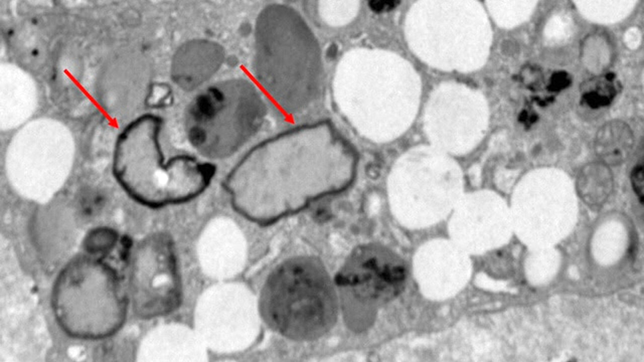 Microplastics in human arteries: doubled risk of heart attack and stroke