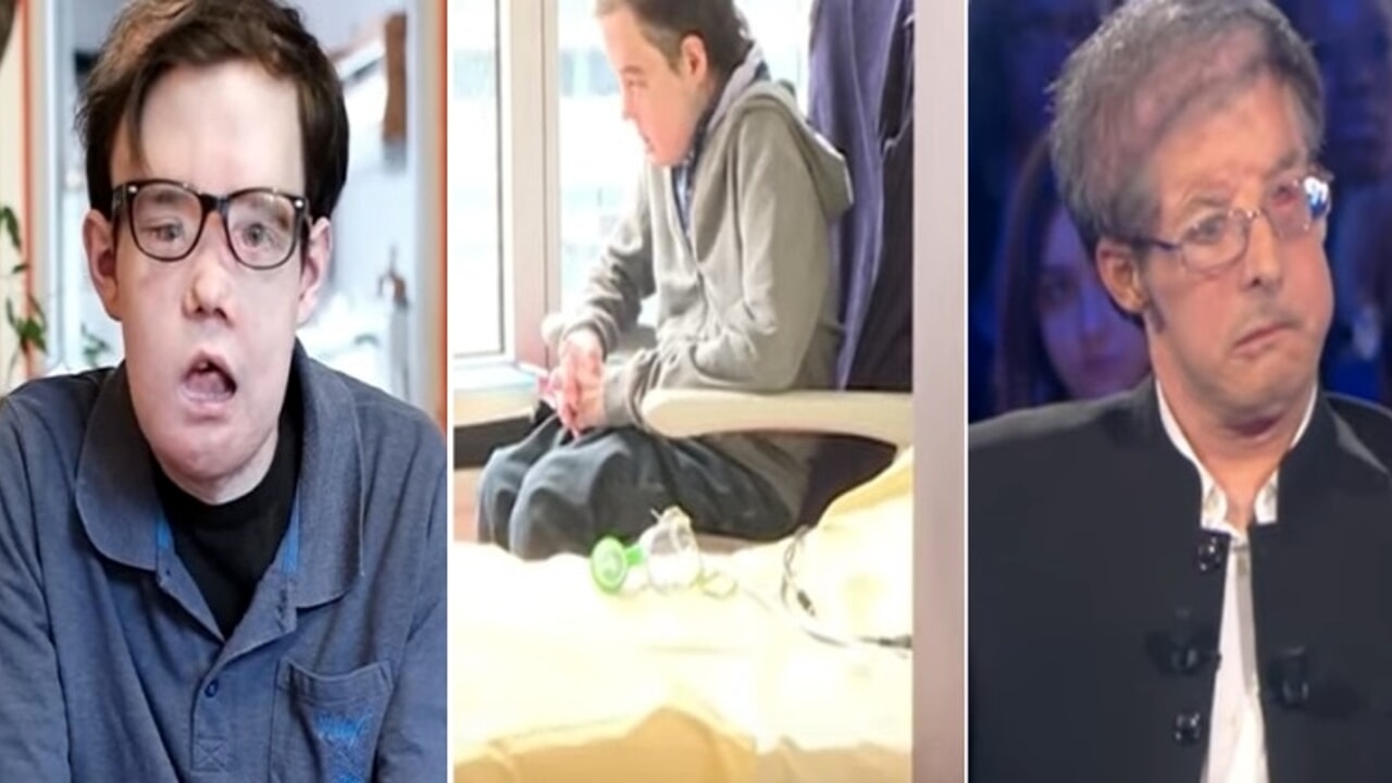 The man who lived with three different faces has died