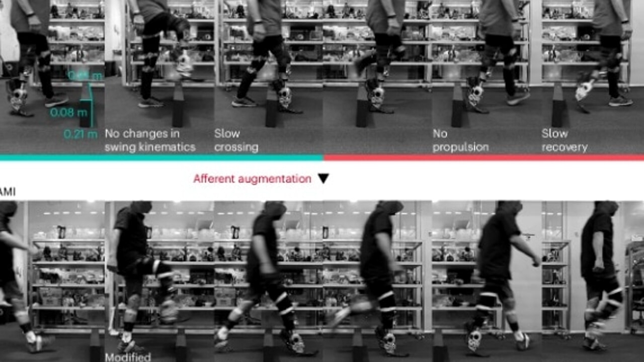Amputee Patients Walk Again With Bionic Leg Controlled Only by Brain