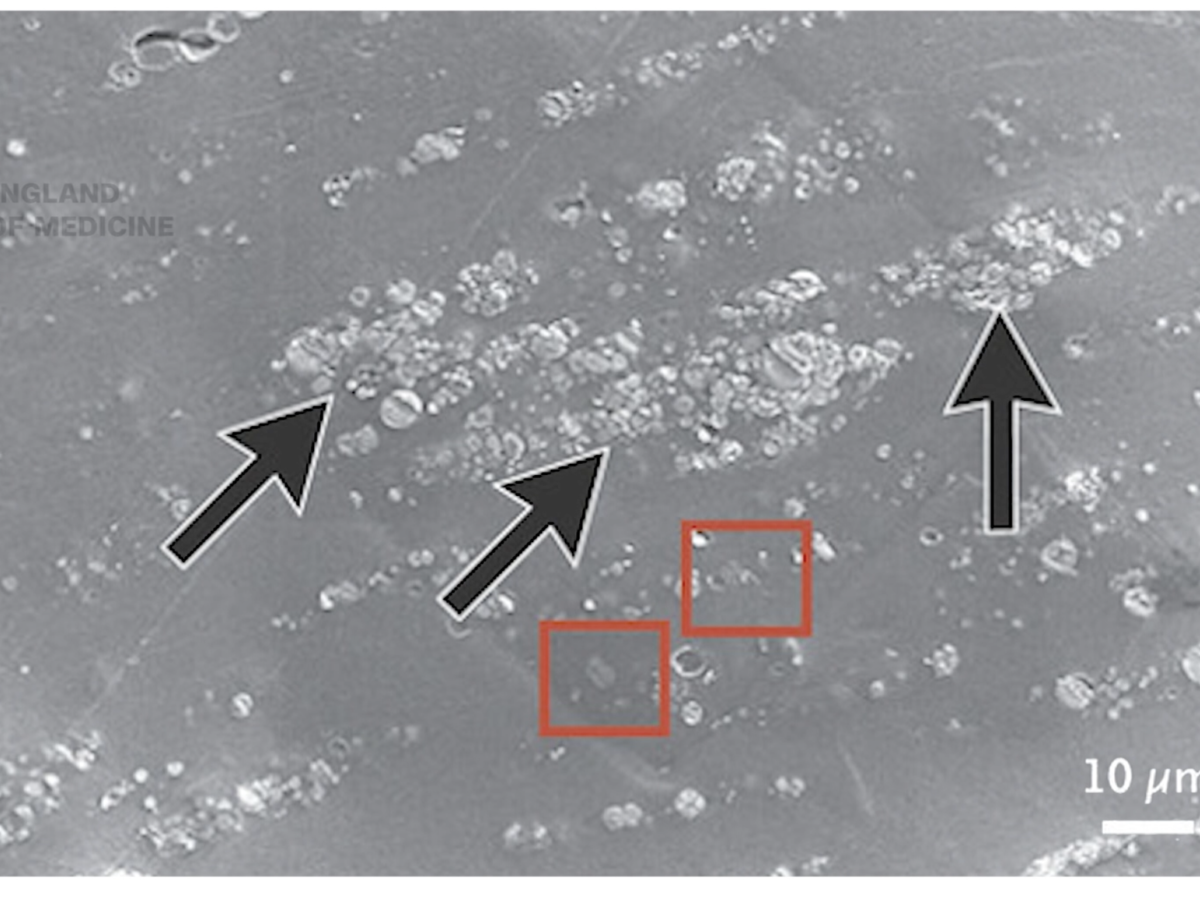 "Surprising Levels of Plastic." New Human Brain Study Reveals