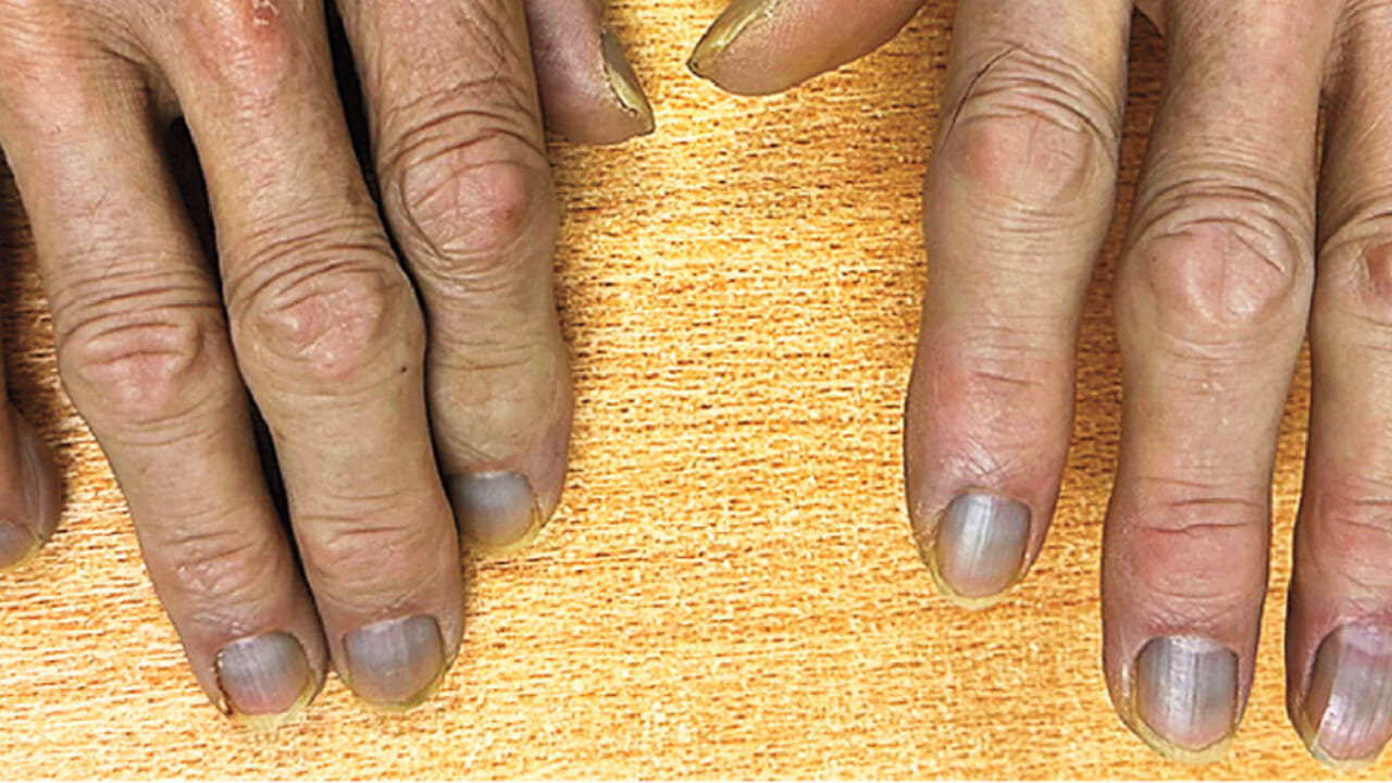 The mystery of man who has become gray, and nobody knows why