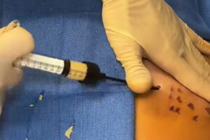 Retouching with corpse fat after the Ozempic effect: the new trend for toning the body emptied by fast diets