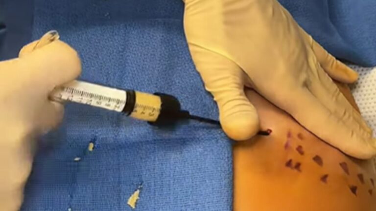 Retouching with corpse fat after the Ozempic effect: the new trend for toning the body emptied by fast diets