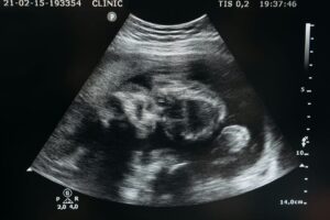 The fetus has a malformation: couple asks for compensation of 600 thousand dollars from the surrogate mother