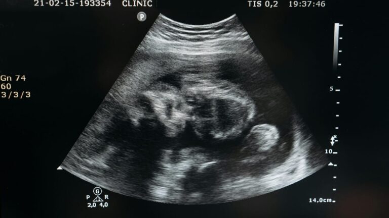 The fetus has a malformation: couple asks for compensation of 600 thousand dollars from the surrogate mother