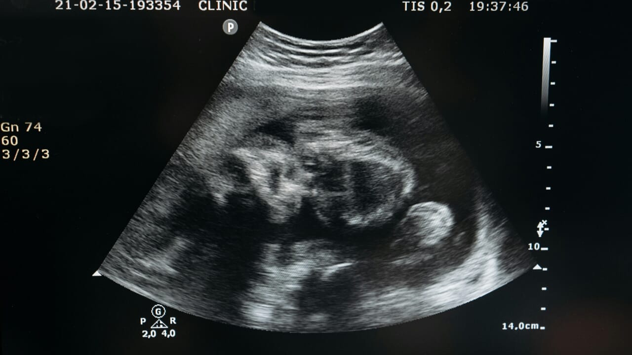 The fetus has a malformation: couple asks for compensation of 600 thousand dollars from the surrogate mother