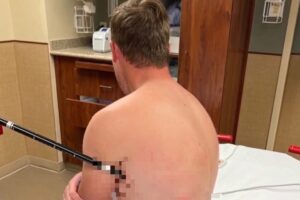 Hiker walks for six hours with a trekking pole in his side: he wanted to save on rescue costs