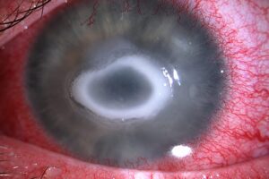 The eye-eating amoeba isn’t the most dangerous thing to put your eyesight at risk this summer