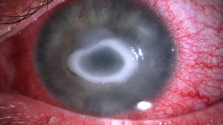 The eye-eating amoeba isn't the most dangerous thing to put your eyesight at risk this summer