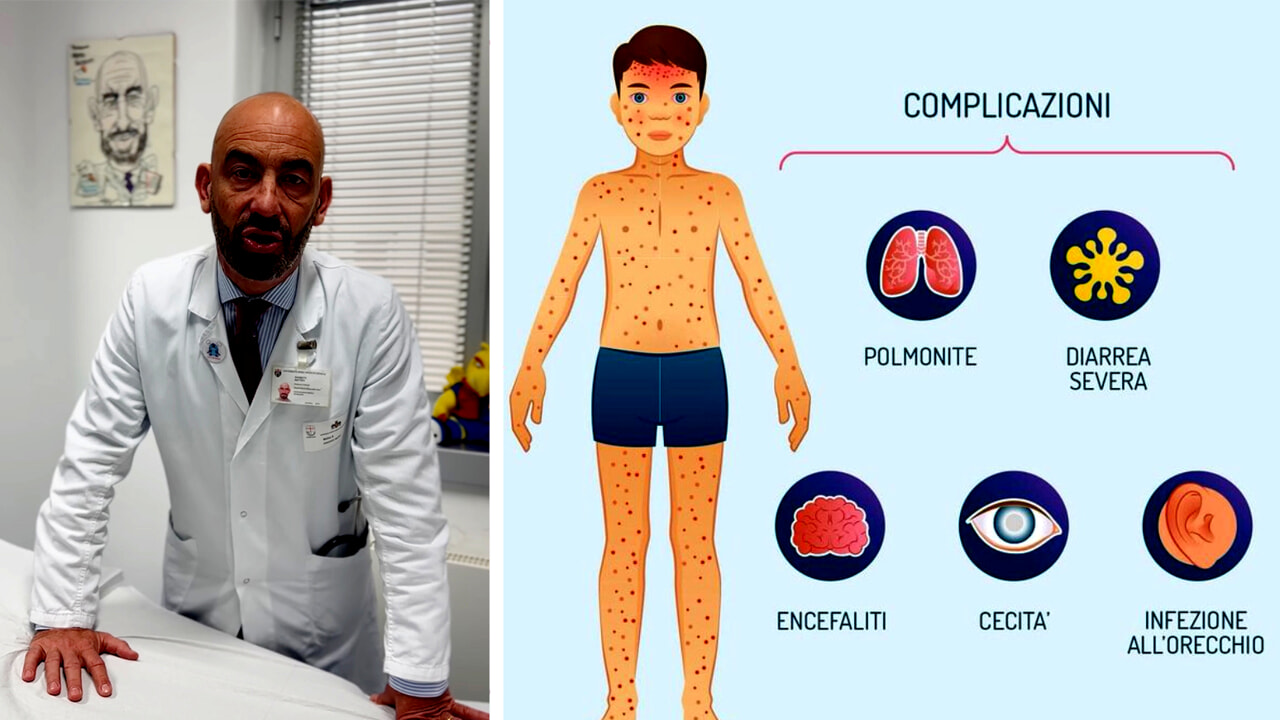 Measles, there is a new alarm: why the virus strikes again and what we risk