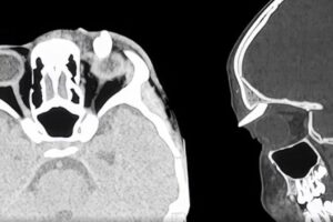 He lives for months with a swelling above the eye, then two sharp points emerge: in the hospital they extract a tooth from the eyelid