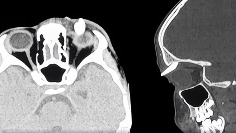 He lives for months with a swelling above the eye, then two sharp points emerge: in the hospital they extract a tooth from the eyelid