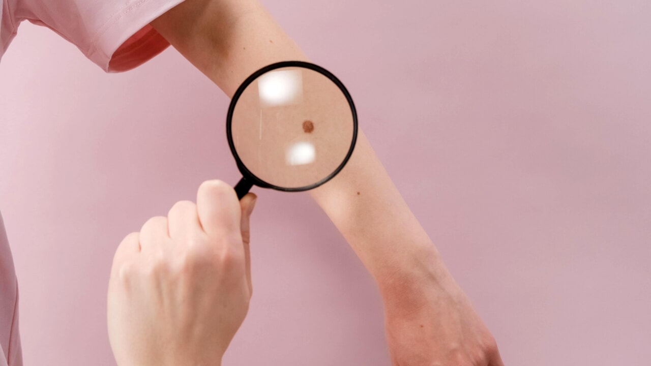 Personalized melanoma vaccine works, but costs millions for each individual patient